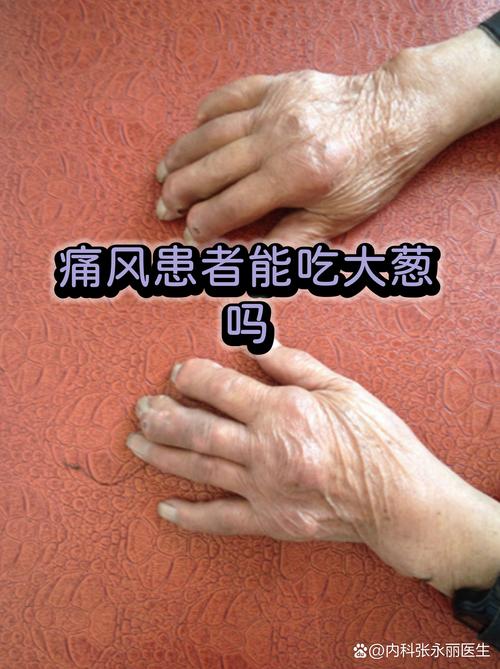 请问痛风能吃洋葱吗