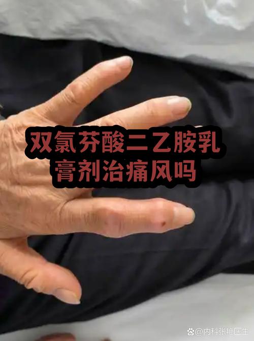 治痛风的软膏有哪些