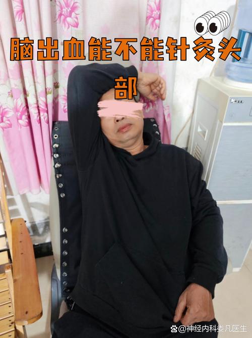 针灸治疗脑出血偏瘫