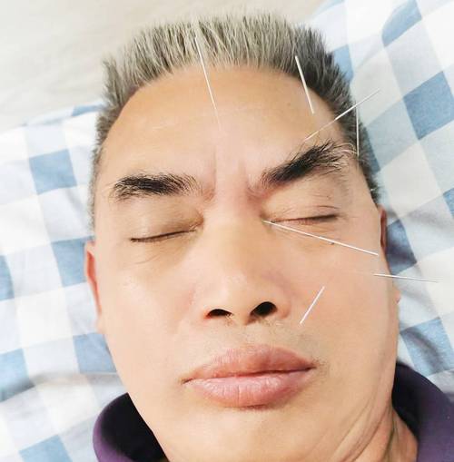 上眼睑下垂自己针灸