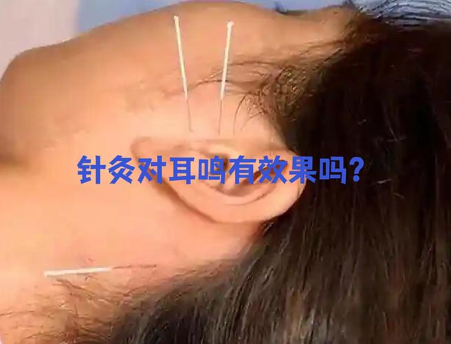 针灸对耳鸣是否有效