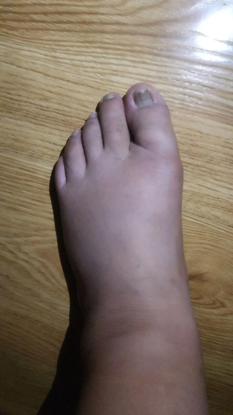 痛风过后脚还不舒服