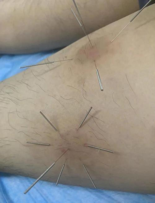 厦门最好的针灸医生