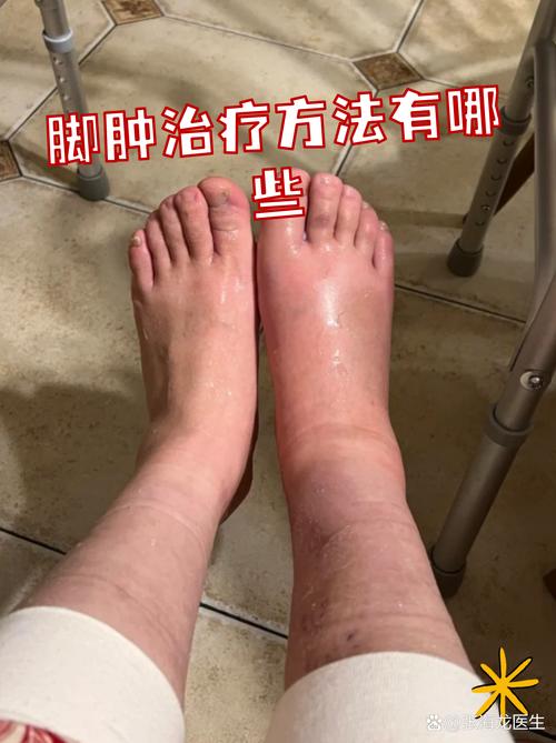 痛风脚肿要怎么消肿