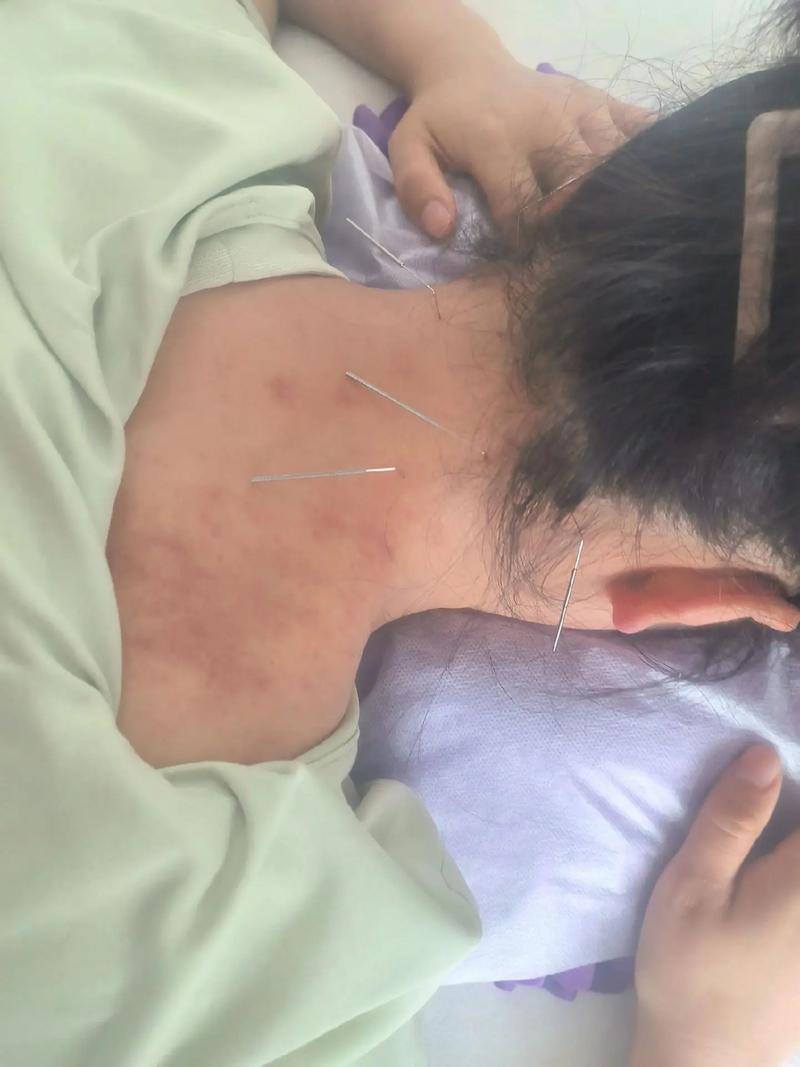 怀孕可以针灸颈椎吗