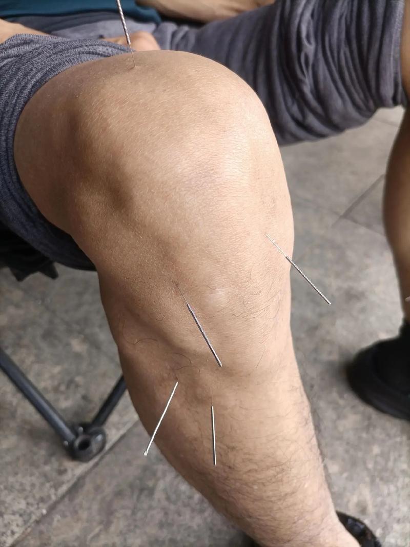 膝盖滑膜炎针灸效果