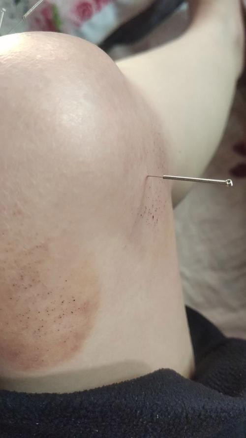 膝盖滑膜炎针灸效果