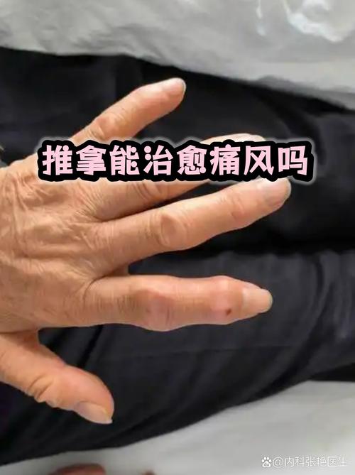 痛风发作可以按摩吗