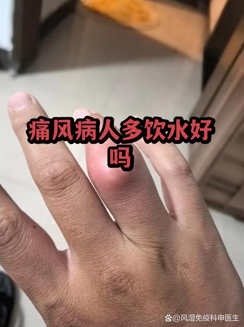 痛风可以喝姜糖水吗