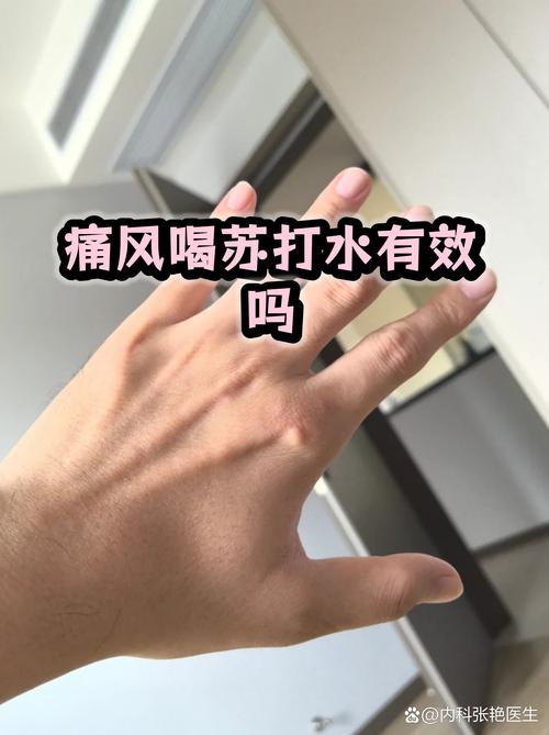 痛风可以喝姜糖水吗