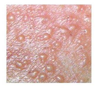 生殖疱疹可以针灸吗