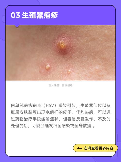 生殖疱疹可以针灸吗