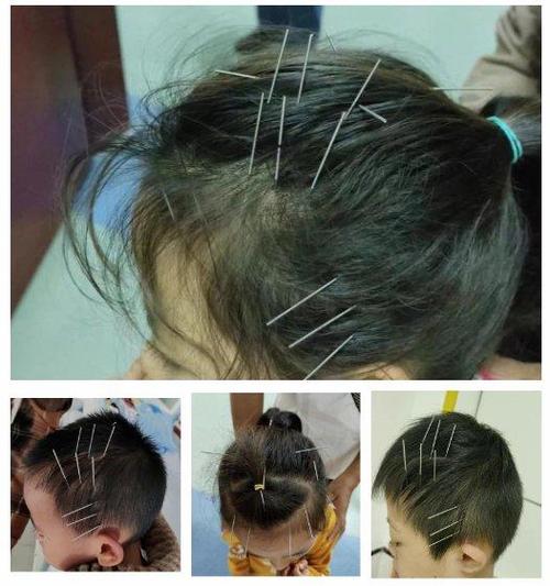 小孩面瘫可以针灸吗