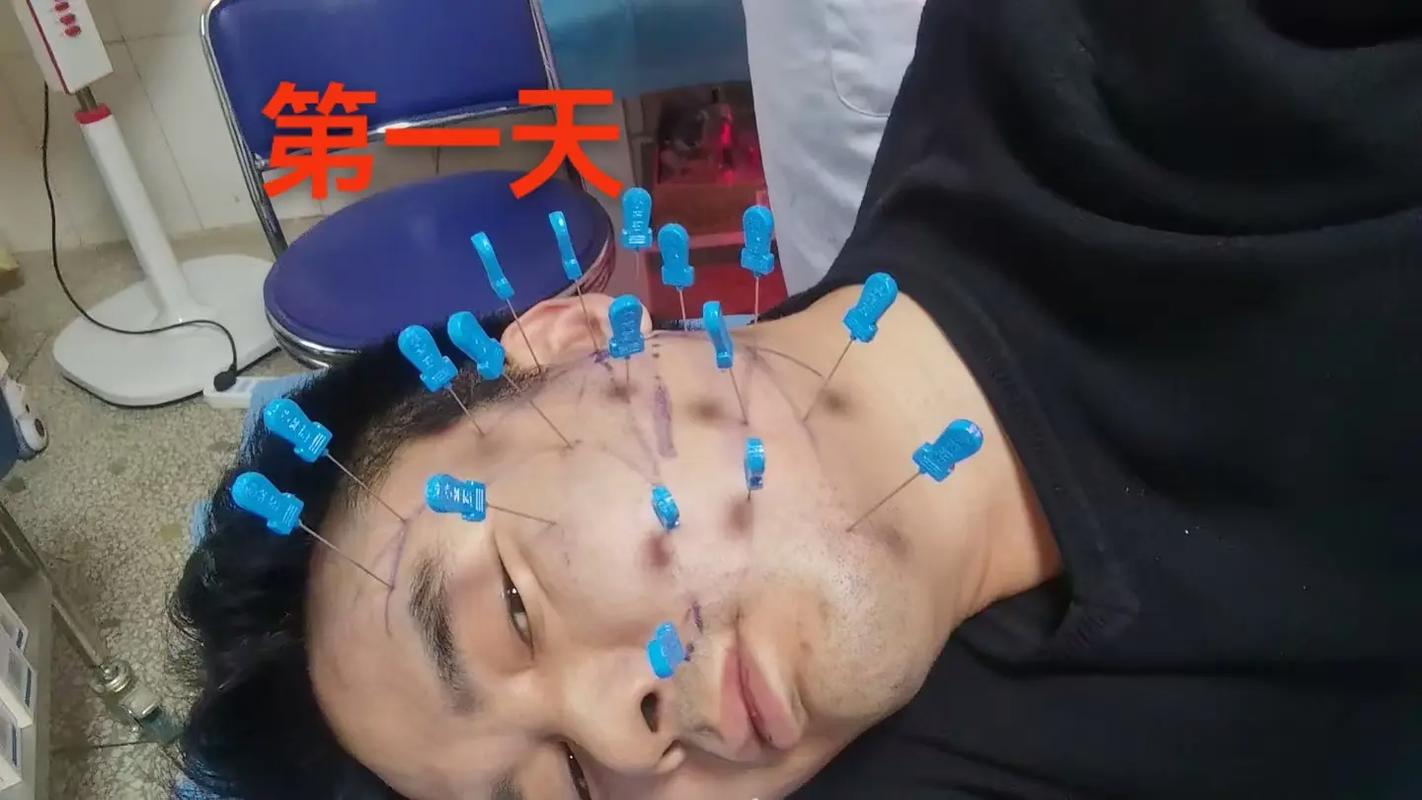 小孩面瘫可以针灸吗