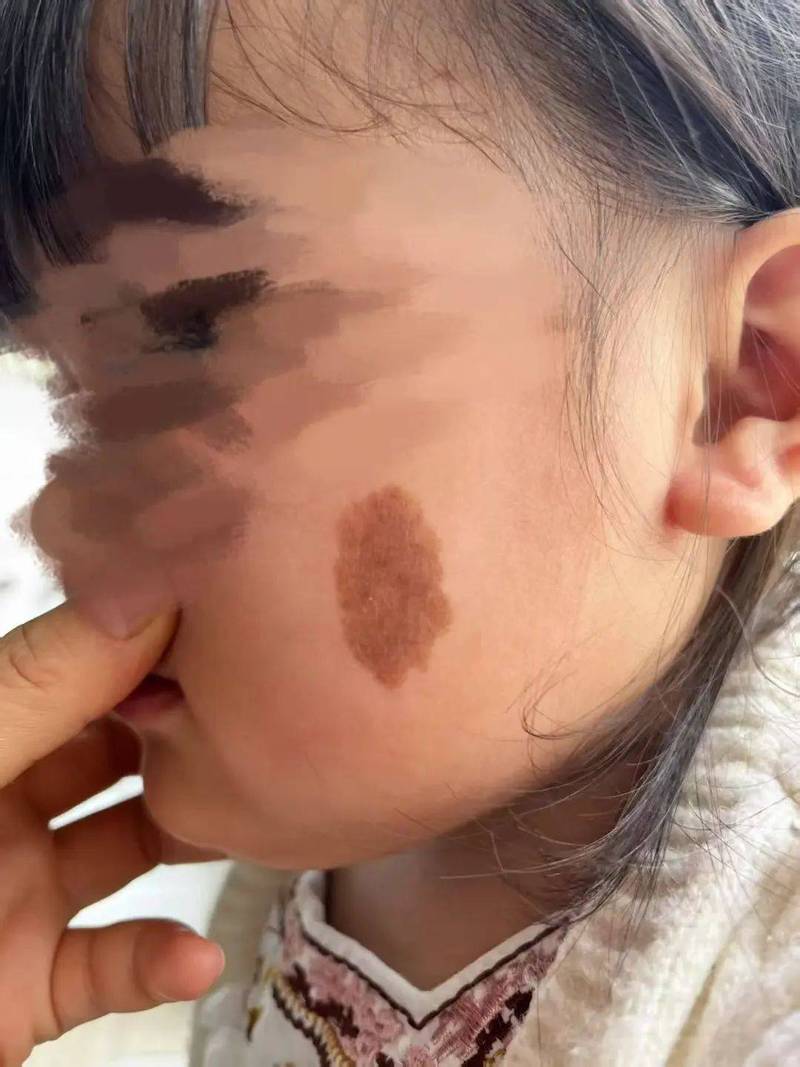 胎记的治疗上复大安全