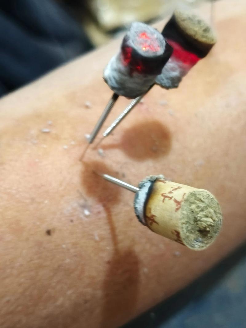 冬天可以针灸减肥吗