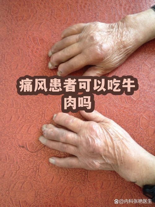 痛风能吃牛肉汉堡吗