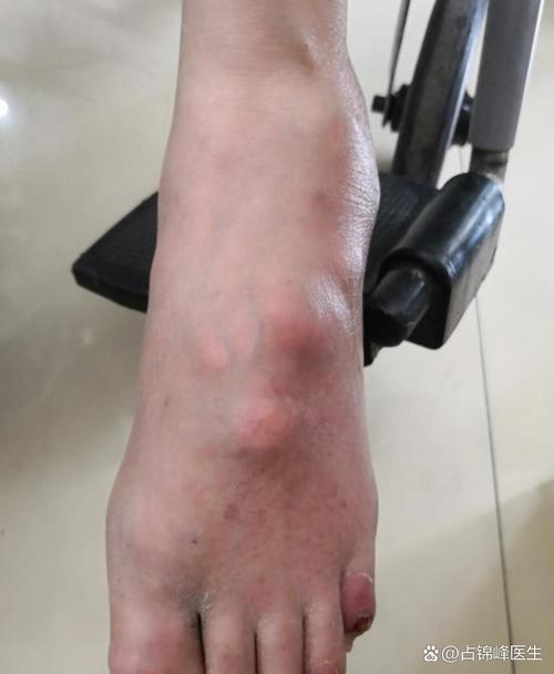 老伤部位经常是痛风