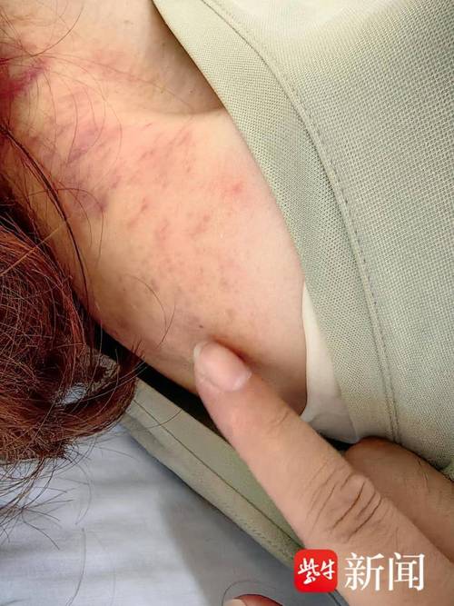 针灸引起气胸严重吗