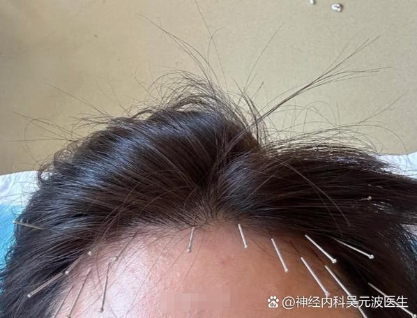 针灸可以治疗脑萎缩