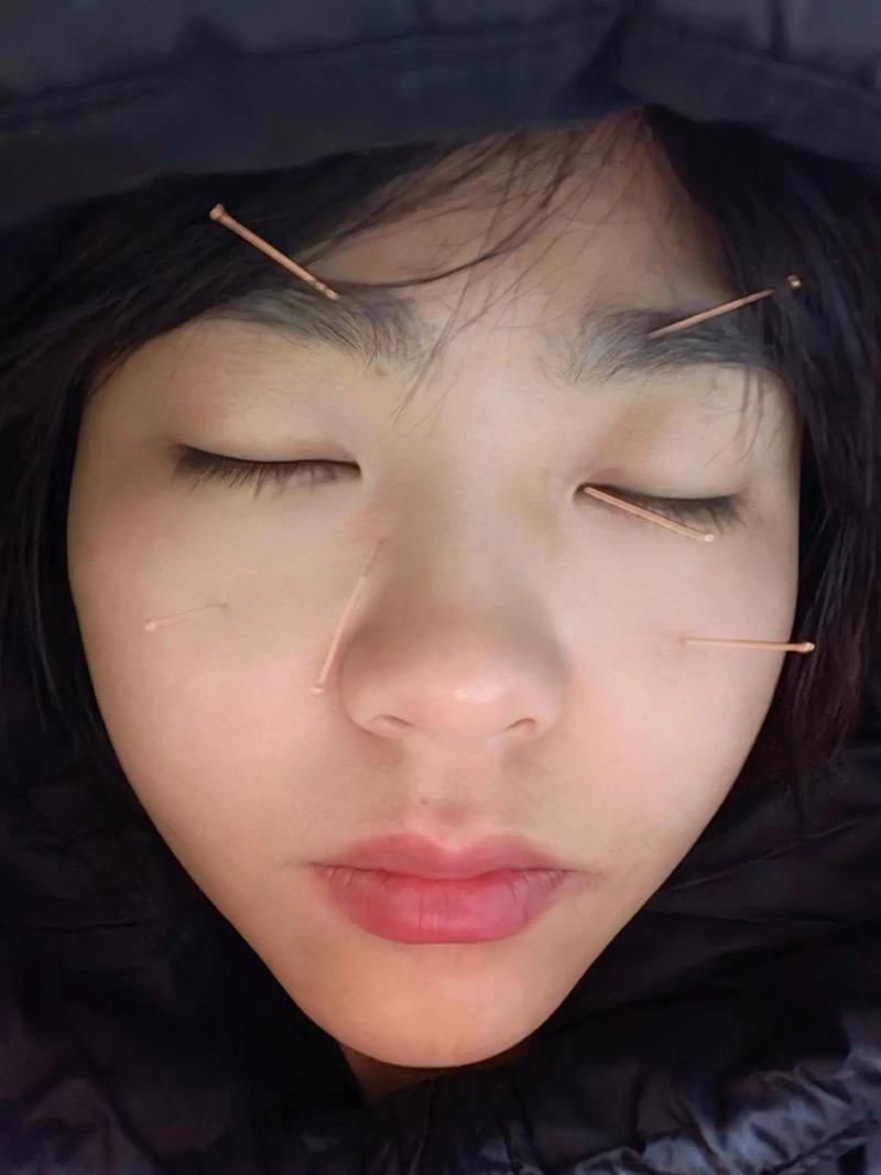 针灸哪个穴位去眼袋