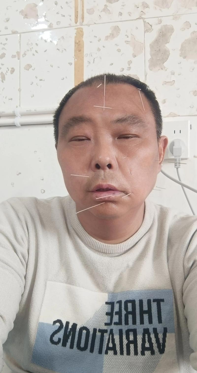 面瘫后几天可以针灸