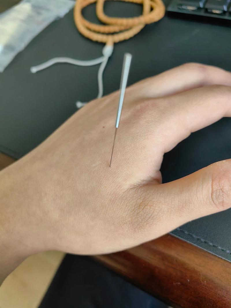 北京哪里可以学针灸