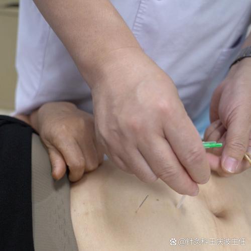 苏州张医生针灸减肥