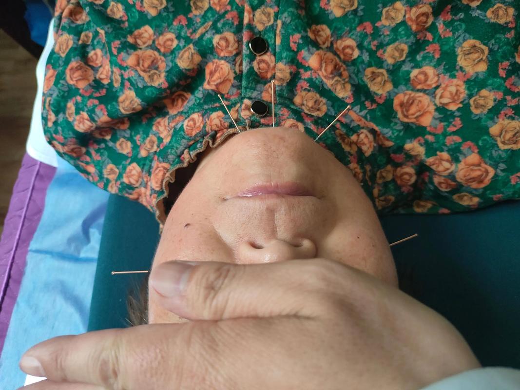 智力低下可以针灸吗