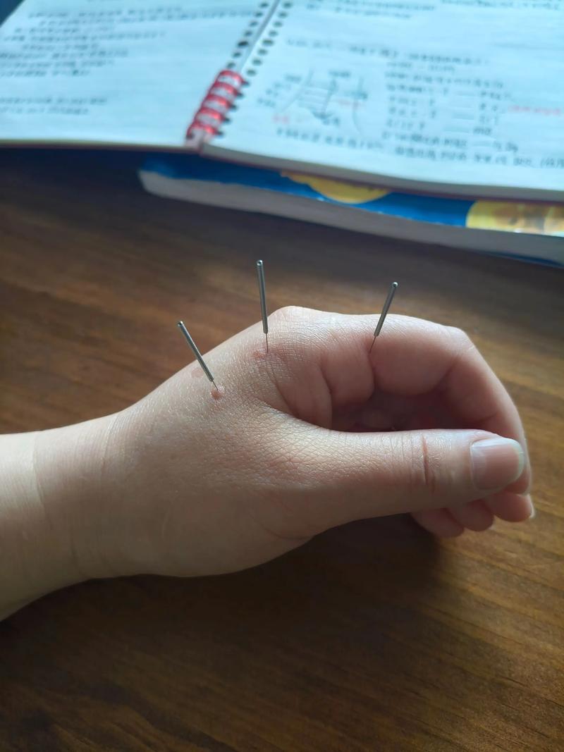 智力低下可以针灸吗