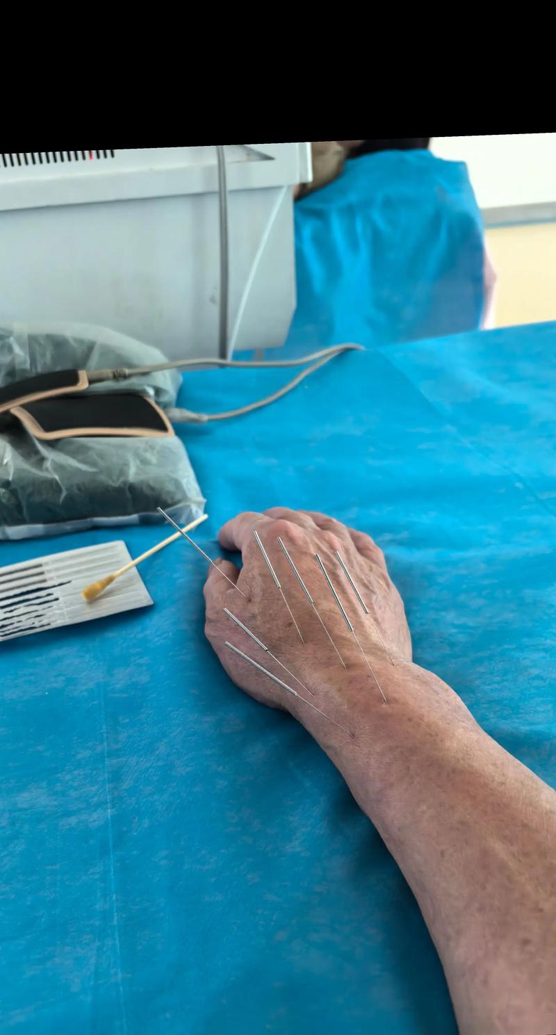 针灸治疗什么病最好