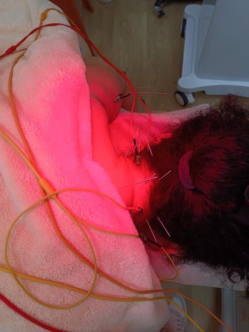 针灸治疗什么病最好