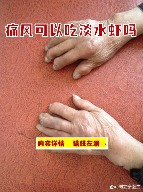 痛风可以吃碱水面吗