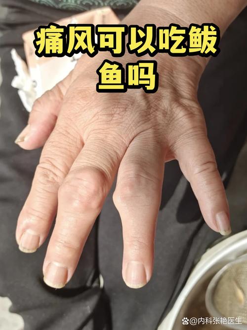 痛风可以吃碱水面吗