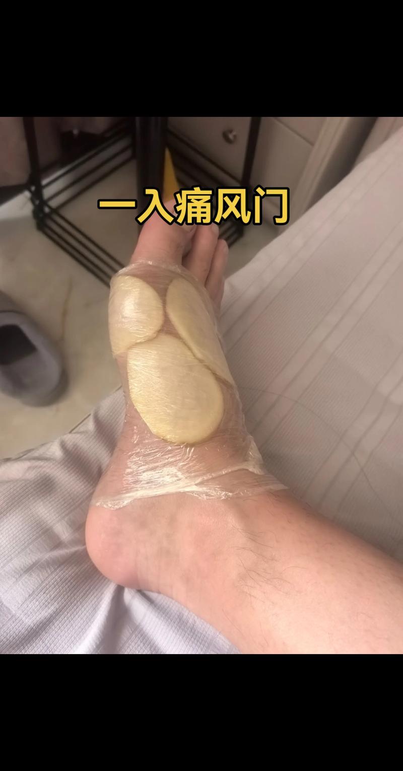 痛风脚消肿后会痒吗