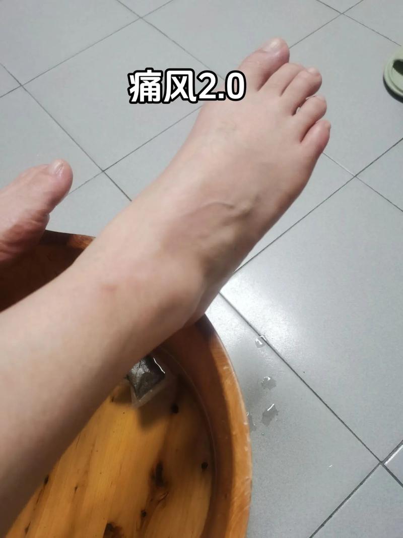 痛风脚消肿后会痒吗