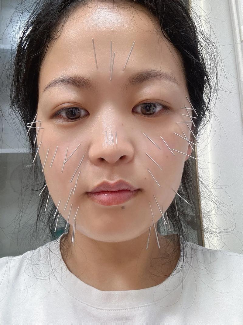 面部皮炎可以针灸吗