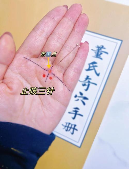 王新民针灸治疗咳嗽