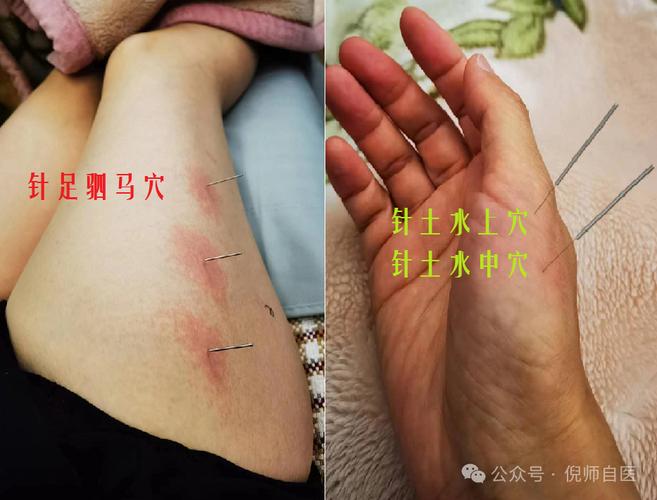 王新民针灸治疗咳嗽