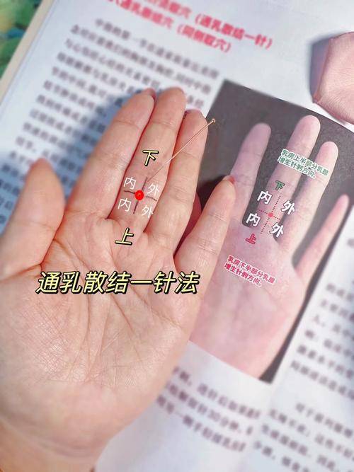 贴针灸治疗乳腺增生