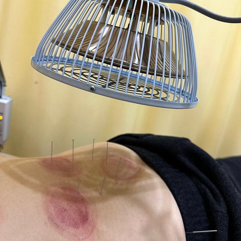 贴针灸治疗乳腺增生