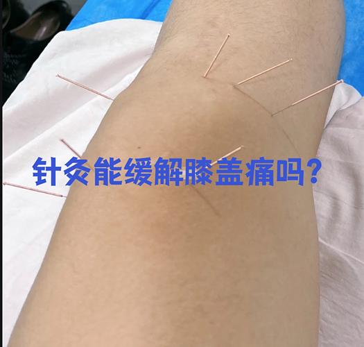 膝盖痛针灸哪个穴位