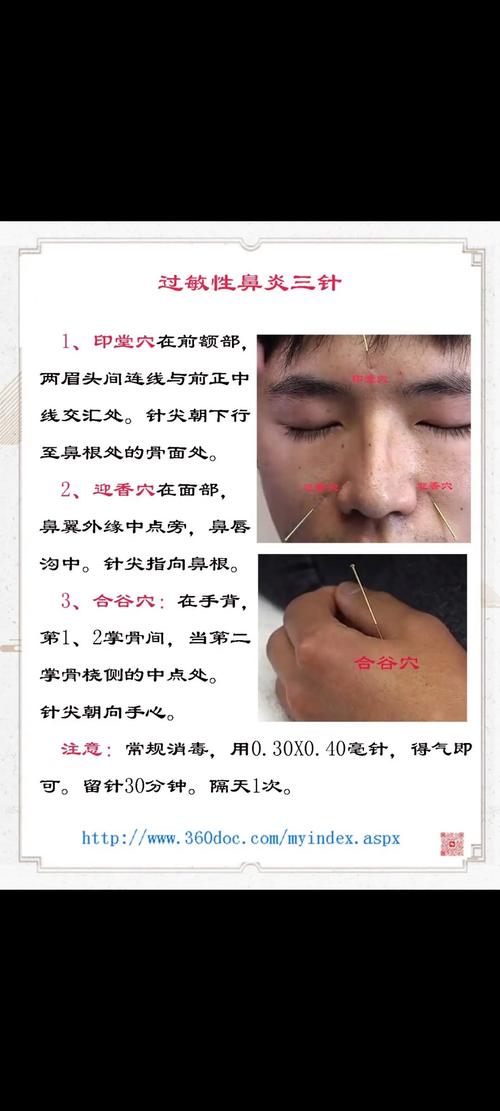 鼻塞艾针灸哪些部位