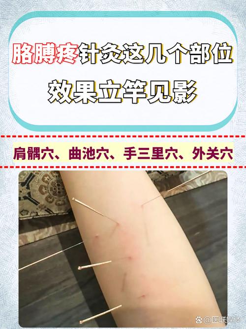 针灸穴位可以治痛风