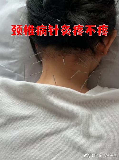 给自己针灸不敢进针