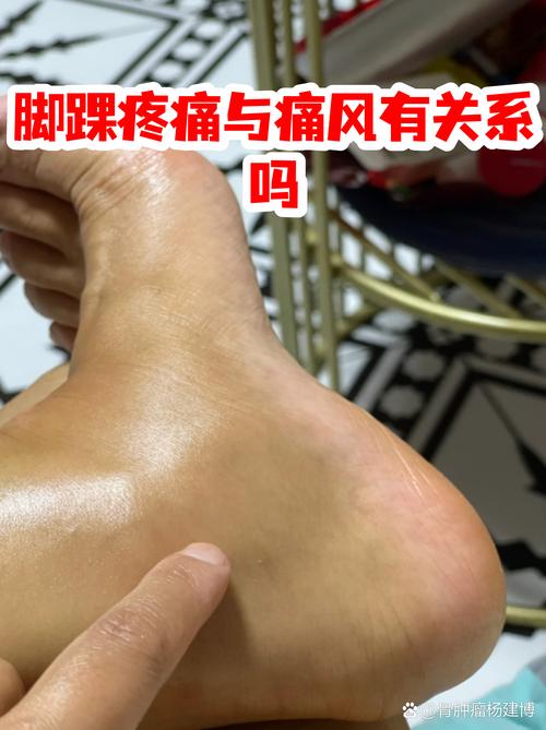 痛风需要把脚抬多高