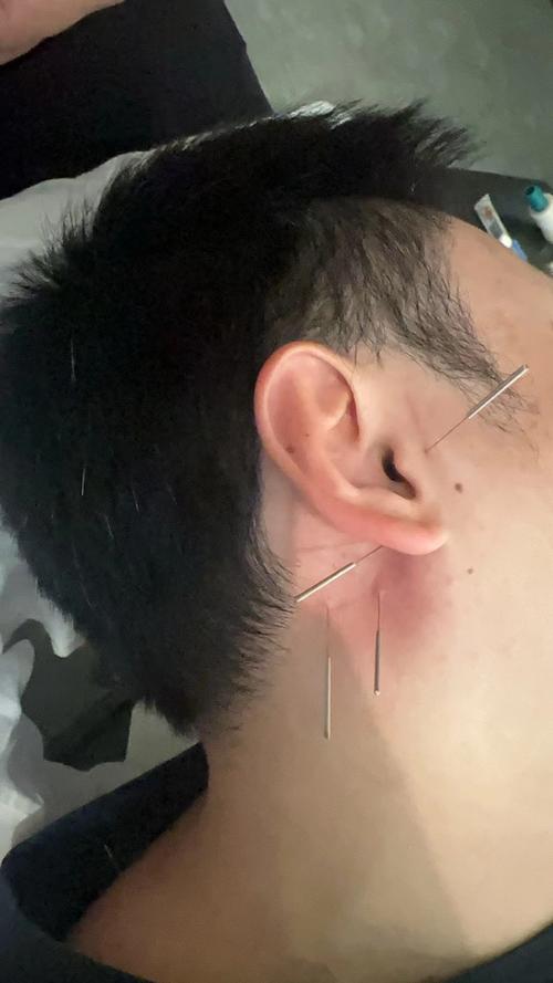 脸部肿胀可以针灸吗