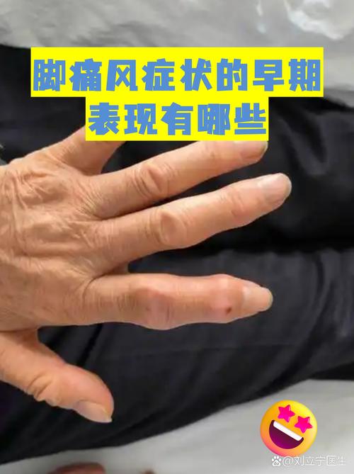 痛风时间长了会怎样