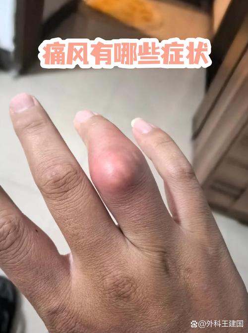 痛风时间长了会怎样