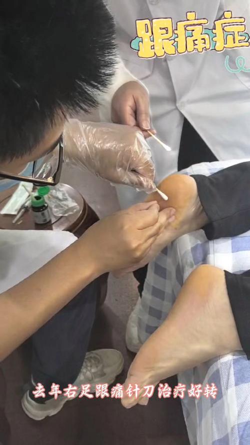 针灸治疗足跟痛视频